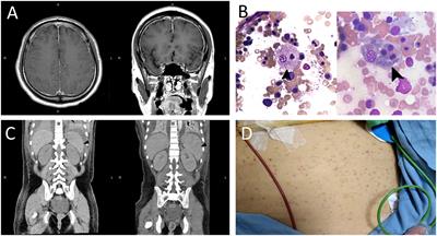 Case report: Hemophagocytic lymphohistiocytosis complicated by multiple organ dysfunction syndrome following aseptic encephalitis